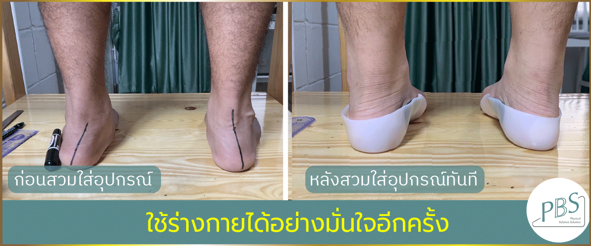 PBS หมอรักษาเท้า โรคเท้าแบน รักษาอาการเท้าผิดรูป แผ่นรองเท้า เท้าแบน รักษาได้  