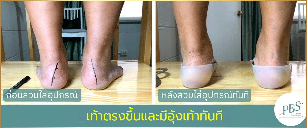 PBS หมอรักษาเท้า โรคเท้าแบน รักษาอาการเท้าผิดรูป แผ่นรองเท้า เท้าแบน รักษาได้  