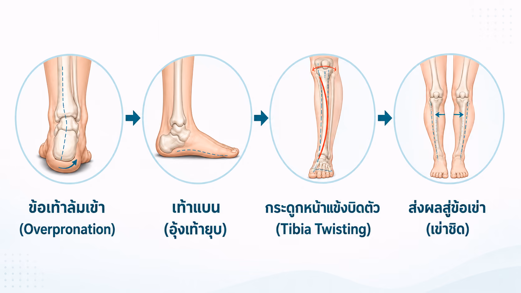 ภาวะเข่าชิด ดูแลครบวงจร พร้อมแผ่นรองเท้าเฉพาะบุคคลที่ PBS