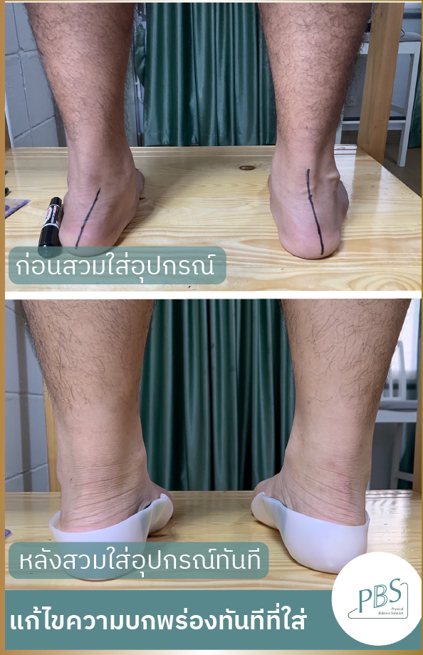 PBS แผ่นรองเท้าเพื่อสุขภาพ แก้รองช้ำ แก้ปวดเท้า โรคเท้าแบน